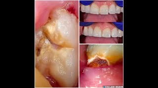 62 Chipped front tooth repair and wisdom teeth extractions [upl. by Caputto801]