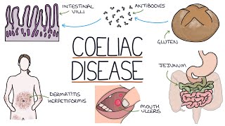 Understanding Coeliac Disease [upl. by Zilvia]