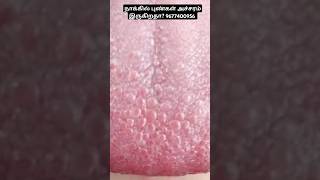 நாக்கில் கொப்புளங்கள் எரிச்சல் இருகிறதா shorts viral trending cankersores mouthsores [upl. by Anitra]