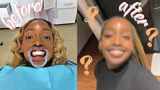 VLOG  GETTING BRACES and doing everything to feel cute afterwards  cheymuv [upl. by Eikcaj]