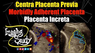 Placenta Previa  Placenta Increta  Morbidly Adherent Placenta  Ultrasound  Doppler  Case 283 [upl. by Weiss]