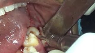 Third Molar Removal Surgery  Why impacted wisdom tooth should be removed [upl. by Hoehne]