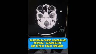 Subarachnoid hemorrhage  subdural hemorrhage  global brain ischemia  CT scan brain pediatrics [upl. by Macdonald28]