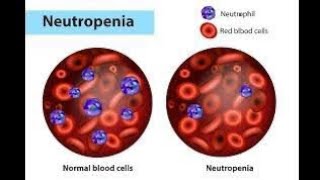 NEUTROPENIA  Definition of neutropenia  Causes of neutropenia [upl. by Carnes]