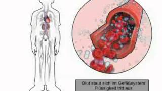 4 Warum Herzinsuffizienz Wassereinlagerungen verursacht [upl. by Conrad]