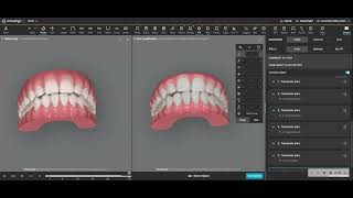 Invisalign is great to widen upper arch and reduce overbite [upl. by Shayn852]