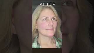 Facelift Surgery Photos Before and After faceliftsurgery [upl. by Ecirual828]