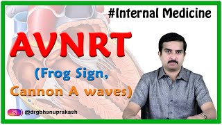 Atrioventricular nodal reentrant tachycardia AVNRT  Internal medicine National USMLE Step 2 ck [upl. by Kassie]