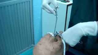 posterior nasal packing ENT PMK [upl. by Atsuj]