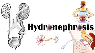 Hydronephrosis  Definition Functional Anatomy Causes Signs amp Symptoms Diagnosis amp Treatment [upl. by Rayburn]