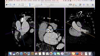 TAVR Planning Using Osirix [upl. by Yhtomot]