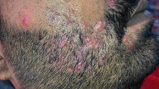 Infected Pimples Medication Stridex Blackheads Skincare Blackheads removal video [upl. by Laynad78]