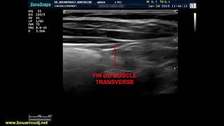 Quadratus lumborum QLB block [upl. by Janeczka]