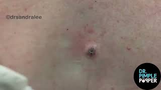 8 Minutes of Satisfying Soft Pops Dr Pimple Popper POPS All Over The Body [upl. by Reinhart505]