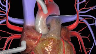 KoronararterienBypass CABG [upl. by Ortensia]