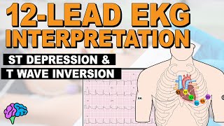 Myocardial Ischemia  ST Depression amp T Wave Inversion  12lead EKG [upl. by Nosnev169]