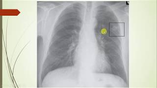 Histoplasmosis a clinical case based review geography symptoms differential diagnosis treatment [upl. by Nelaf330]