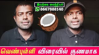 natural vitiligo makeup powder home remedies in tamil 16 May 2023 [upl. by Hsiwhem487]