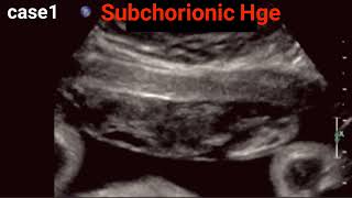 Abruptio Placentae  Ultrasound Basics [upl. by Male]