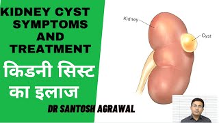 Kidney Cyst Treatment I Renal Cyst I Kidney Ki Gathan [upl. by Anilesor113]