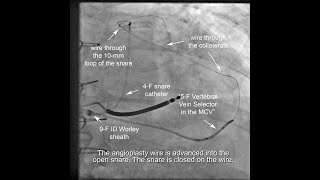 Antidromic snare  Venoplasty  use of micro catheter inside vein selector to traverse collaterals [upl. by Eussoj429]