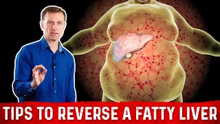 4 Critical Tips to Reverse a Fatty Liver – Dr Berg [upl. by Sanalda]