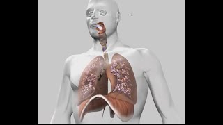 LEFR au service du diagnostic de la fibrose pulmonaire idiopathique [upl. by Nivaj]