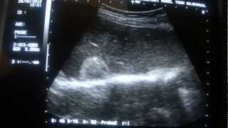 ULTRASOUND LIVER HEMANGIOMAS [upl. by Florance880]