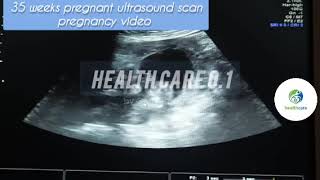 35 weeks pregnant baby ultrasound scan pregnancy video pregnancy ultrasound baby scan video [upl. by Luelle]