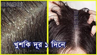 খুশকি মুক্ত চুলের জন্য খুব সহজ ১ টি টিপস। Dandruff Free Hear And Winter Hair Care  Khuski Dur [upl. by Moya259]