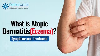 What is Atopic DermatitisEczema  Symptoms and Treatment  DermaworldDelhi DrRohitBatra [upl. by Innavoeg]