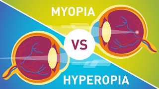 Difference between Myopia Near Sightedness amp Hyperopia FarSightedness [upl. by Nueoras]