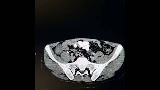 Tuberculosis involving terminal ileum ileocecal junction caecum and ascending colon [upl. by Nodarb]