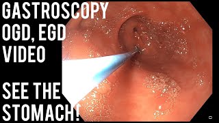 Gastroscopy  OGD  See inside the stomach [upl. by Akemej879]