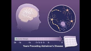 Biomarker Changes Preceding Alzheimer’s Disease  NEJM [upl. by Audras]