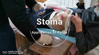 How To Apply of Coloplast Paste Alterna Adaptor amp Alterna 2Pcs Drainable Disposable Bag to Stoma [upl. by Akirahc297]