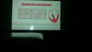 Taquiarritmias parte 1 [upl. by Elitnahc]