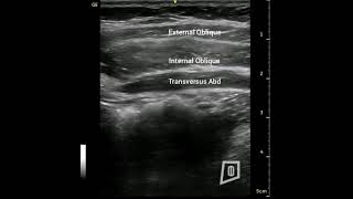 Rehabilitative Ultrasound Imaging of the Transversus Abdominis [upl. by Airolg]