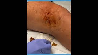 MoraMD My Knee Fluid Removal Technique It does not have to hurt [upl. by Vyky373]