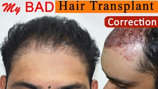 BAD Hair Transplant Correction at Medispa By Dr Suneet Soni  Failed Hair Transplant Repair [upl. by Saw355]