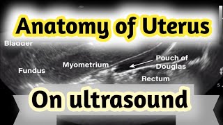 Sonographic Anatomy of UterusGyneacological ultrasound [upl. by Linetta]