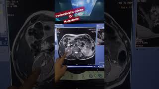 MRI KIDNEY SCAN MRI KIDNEY HEMATOMA or Perinephric Odemamri upper abd [upl. by Teloiv]