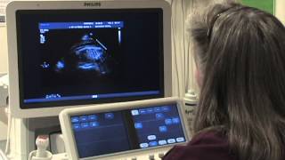 What Is a Fetal Echochardiogram Test [upl. by Bilak]