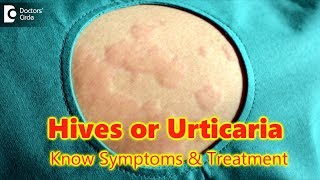 Hives  UrticariaCausesSymptomsTreatment  Skin Rash  Allergy  DrRasya Dixit  Doctors Circle [upl. by Miharbi]