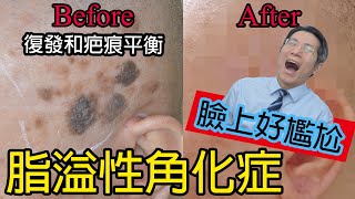 脂溢性角化症 Seborrheic Keratosis Senile wart 老人斑 黑色腫塊 皮膚手術 皮膚專科 [upl. by Shrier819]