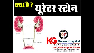 URETER STONE यूरेटर स्टोन [upl. by Asial48]