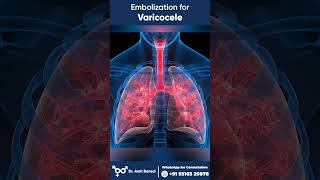 Varicocele I Varicocele Embolization I Embolization for Varicocele [upl. by Atled]