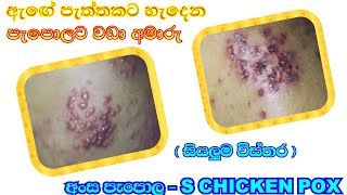 Ansa pepola  chickenpox sinhala  Sakalawaga [upl. by Salazar]