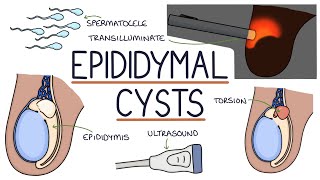 Understanding Epididymal Cysts [upl. by Rose]