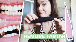 HOW TO REMOVE CALCULUS TARTAR PLAQUE AT HOME  Ultrasonic Tooth Cleaner Review  Does It Work [upl. by Suzi328]